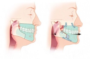 MMA Surgery Maxillo Mandibular Advancement Diagram