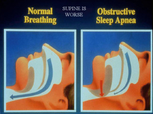 Picture of normal breathing vs. breathing with obstructive sleep apnea