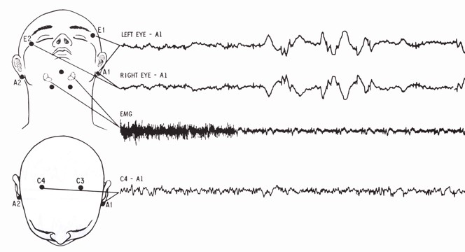 Standard sites for polysomnographic electrode placements