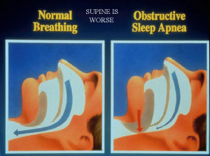 Causes of Sleep Apnea Breathing